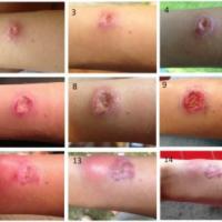 
	Leishmaniasis - over a 10 week period