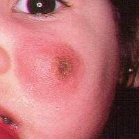 
	Leishmaniasis

	Copied with kind permission…