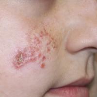 
	Leishmaniasis recidivans

	Active red papules…
