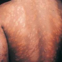 
	Lepromatous leprosy