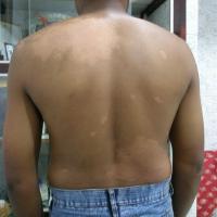 
	Lepromatous leprosy