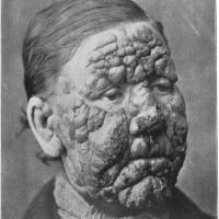 
	Lepromatous leprosy&nbsp;