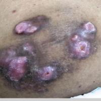 
	Lepromatous leprosy

	Nodules and plaques