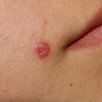 
	Leishmaniasis

	Copied with kind permission…