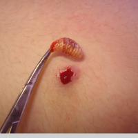 
	Myiasis