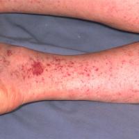 
	Rocky Mountain spotted fever