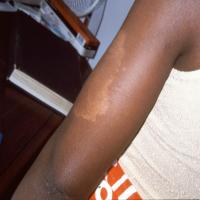 
	Tuberculoid leprosy&nbsp;