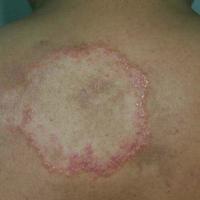 
	Tuberculoid leprosy