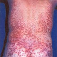 
	Dengue fever

	Haemorrhagic change