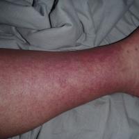 
	Dengue fever