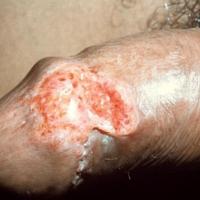
	Granuloma inguinale (syn. Donovanosis)