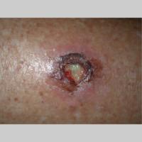
	Leishmaniasis

	&nbsp;

	&nbsp;