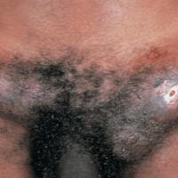
	Lymphogranuloma venerum