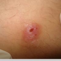 
	Myiasis