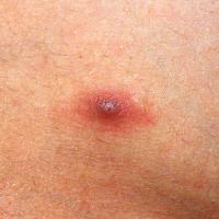 
	Myiasis