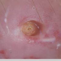 
	Myiasis
