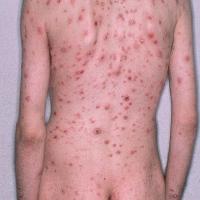 
	Secondary syphilis

	Copied with kind…
