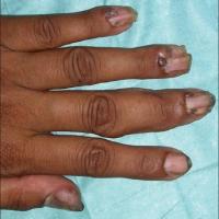 
	Periungual fibromas
