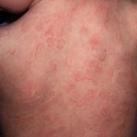 
	Acute urticaria - annular lesions&nbsp;