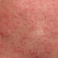 
	Cholinergic urticaria - a chronic…