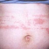 
	Delayed pressure urticaria - a chronic…