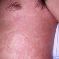 
	Chronic spontaneous urticaria in an adult