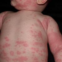 
	Acute urticaria