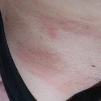 Same case as previous image
Effects of tight…