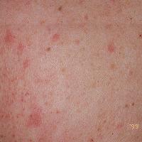 
	Cholinergic urticaria 

	Copied with kind…