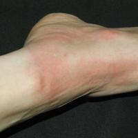 
	Solar urticaria

	Copied with kind permission…
