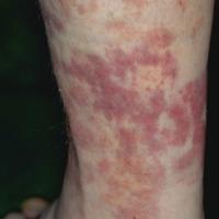 
	Urticarial vasculitis

	Lesions demonstrate…