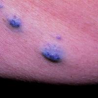 Blue Rubber Bleb Naevus syndrome