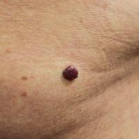 Cherry angioma