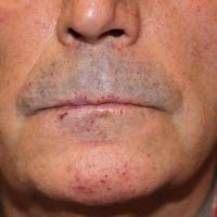 Hereditary haemorrhagic telangiectasia