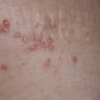 Lymphangioma circumscriptum