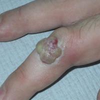 Pyogenic granuloma&nbsp;