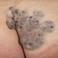 Venous malformation (congenital)&nbsp;