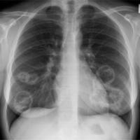 
	Wegener&rsquo;s granulomatosis

	Chest…