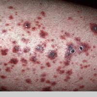 
	Cutaneous small vessel vasculitis

	Palpable…