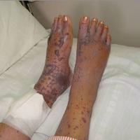 
	Churg-Strauss syndrome

	Palpable purpura