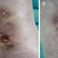 
	Cutaneous PAN