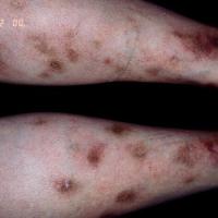 
	Nodular vasculitis&nbsp;

	Copied with kind…