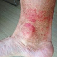 
	Exercise-induced vasculitis

	Mild, occured…