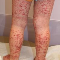 
	Henoch&ndash;Sch&ouml;nlein purpura

	Palpable…