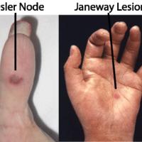 
	Infective endocarditis - causing a septic…