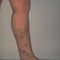 
	Nodular vasculitis