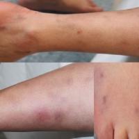 Cutaneous PANPainful, tender nodulesImages copied…