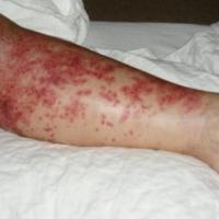 
	Rheumatoid vasculitis 