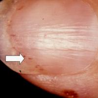 
	Subungual (splinter) haemorrhages (arrow)

	Are…