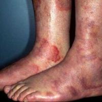 
	Urticarial vasculitis

	Angulated lesions…
